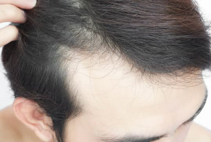 Hair Fall Profile